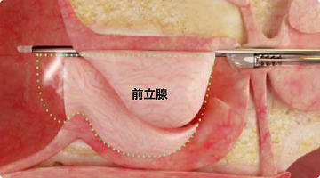 後遺症リスク低減