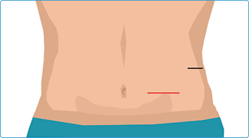 腎がん、腎盂尿管がん、副腎腫瘍、腎盂尿管移行部狭窄症