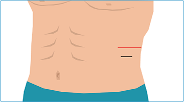 腎がん、副腎腫瘍