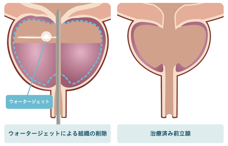 前立腺組織の切除