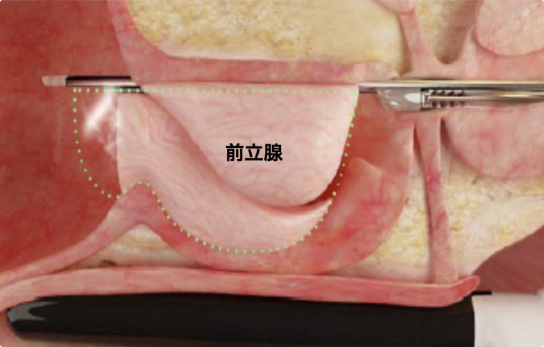 ハンドピース（先端にノズルが付いた棒状の器具）挿入イメージ