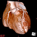 冠動脈CT（心臓CT）