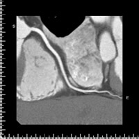 CPR画像（冠動脈が写されている）