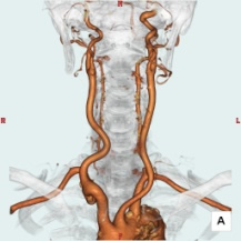 頭頸部　血管CT