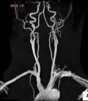 頸部造影MRA