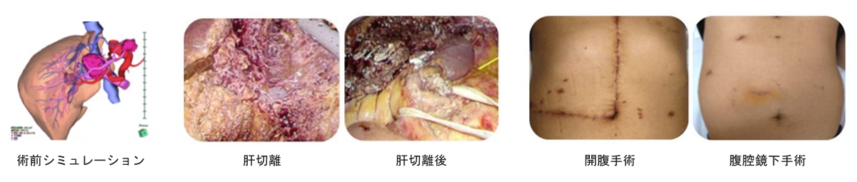 腹腔鏡下肝切除術