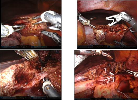 ロボット肝切除画像
