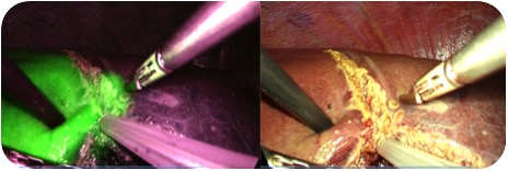 ICG蛍光法併用腹腔鏡下肝切除術