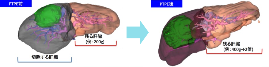 経皮経肝門脈塞栓術（PTPE）