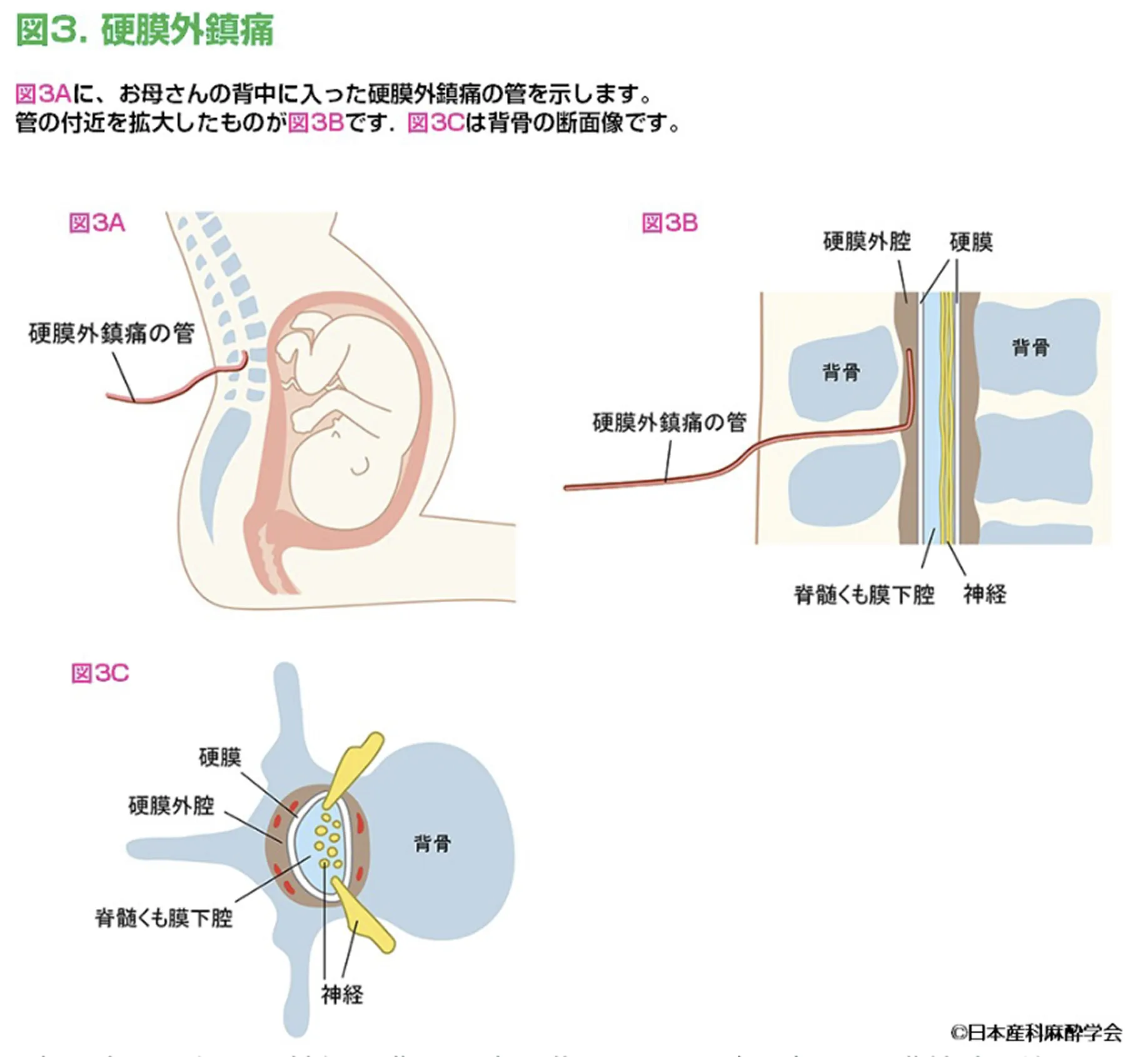 図3 硬膜外鎮痛法