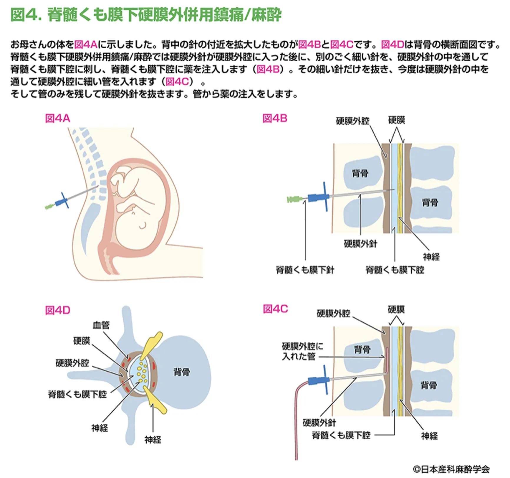 図4 脊髄くも膜下硬膜外併用鎮痛/麻酔