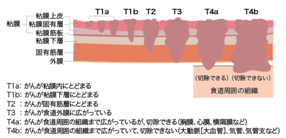 食道がん 済生会横浜市東部病院