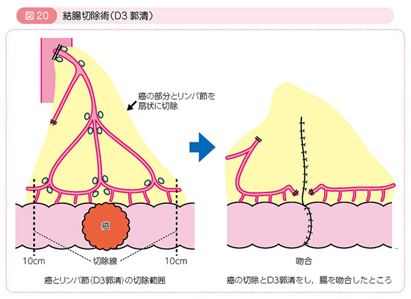 大腸がん 済生会横浜市東部病院 大腸がん 済生会横浜市東部病院