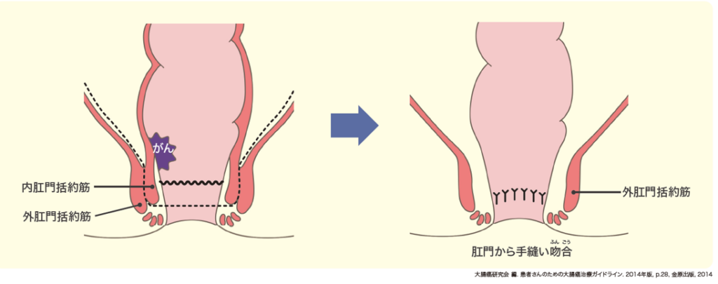大腸がん  済生会横浜市東部病院