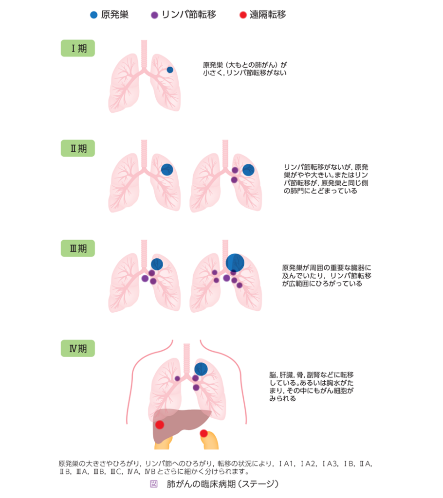 右腕 の 痛み 肺がん